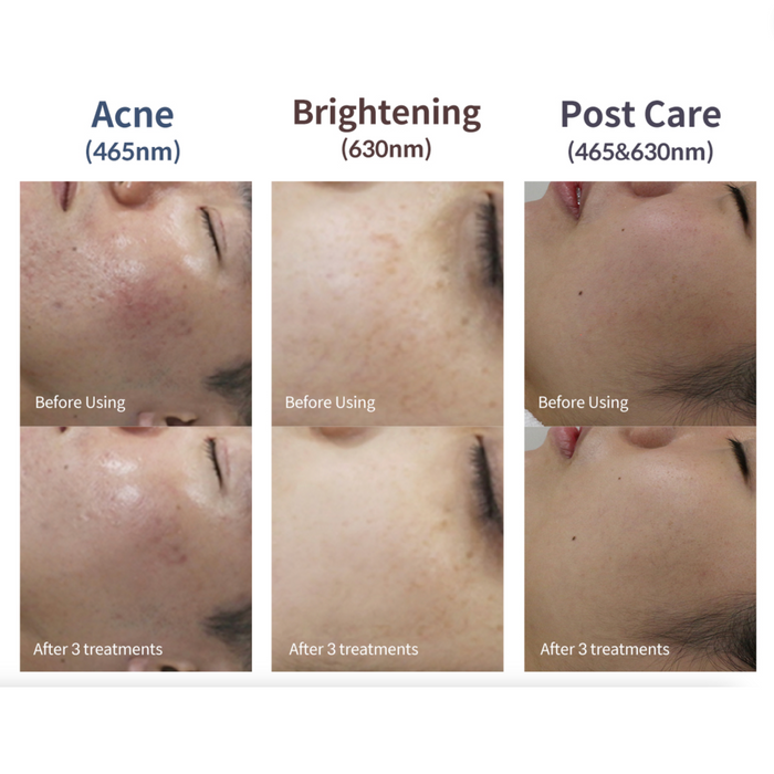 Astrodome Facial | Oxygen & Anion Therapy
