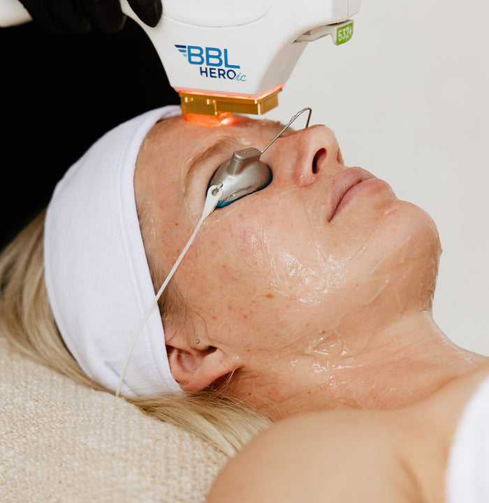 A person receiving a skin treatment with the BBL HERO device, which is used for non-invasive skin lifting and tightening.